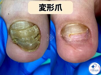 プラスワンフット 本厚木(+1 Foot)/変形・肥厚した爪を正常な爪へ