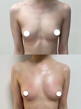 ワイサロン(Y salon)/バストアップ/7ヶ月/C→Fカップ