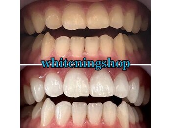 ホワイトニングショップ 長岡京店/ホワイトニングビフォーアフター