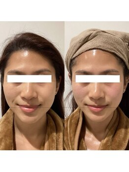 ラバ 名古屋栄店(LAVA)/小顔コルギ【むくみケア】