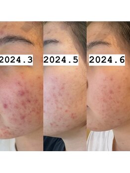 ポーラ 大阪十三店(POLA)/本気のニキビ改善