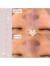 【お肌を綺麗に】ハイドラフェイシャル＋肌別美容成分パック