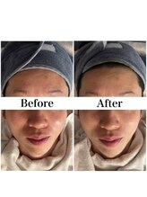 リフェイス(Re:face)/Wピール＋純国産ハーブ