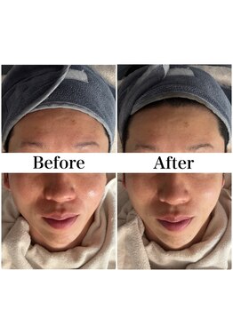 リフェイス(Re:face)/Wピール＋純国産ハーブ