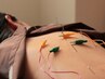 【足のむくみ/疲労感へ】鍼施術（30分コース）電気鍼で驚愕の軽さを体感◎ 