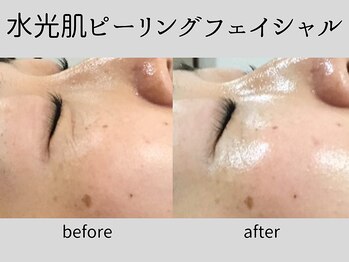 マーベル(MaaBelle)/30代/水光肌ピーリング