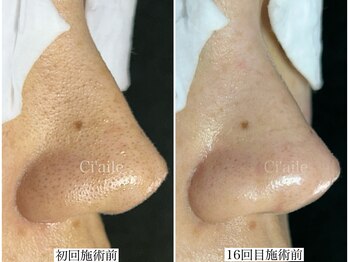 シエール 調布(Ci'aile)/毛穴集中ケア