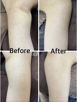 エミルカ 新宿(EMILUCA)/ハーブピーリング専門店です♪