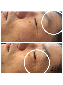 ミチル(Michill)/バクテリウムピール(L)