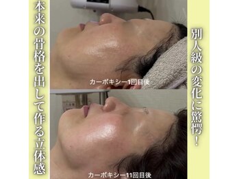 ハニエル(Haniel)/カーボキシー症例