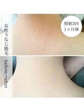 ココスターリー 香椎店(Coco starry)/女性・照射3回☆1ヶ月後