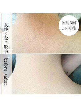 ココスターリー 香椎店(Coco starry)/女性・照射3回☆1ヶ月後