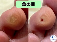 プラスワンフット 本厚木(+1 Foot)/タコ・魚の目ケア！痛みから解放