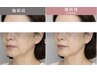 【垢抜け小顔！！10日間限定】小顔リンパ＆蓄熱式超音波14000円→11000円
