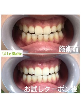 ルブラン 奈良店(Le Blanc)/太陽の下で映える白い歯！