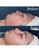 エクリア(ECLIA)/フェイシャル Before⇒After