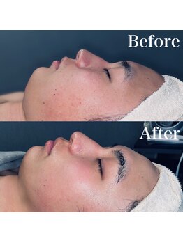 エクリア(ECLIA)/フェイシャル Before⇒After