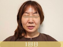 アントルーチェ 代々木上原(Entluce.)/ヒト臍帯幹細胞培養上清液