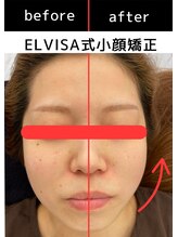 エレヴィザ トウキョウ 恵比寿院(ELVISA TOKYO)/ELVISA式小顔矯正半顔ビフォアフ