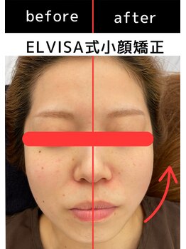 エレヴィザ トウキョウ 恵比寿院(ELVISA TOKYO)/ELVISA式小顔矯正半顔ビフォアフ