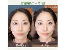 諏訪の杜鍼灸院の雰囲気（目の開き、血流改善、リフトアップなどの効果◎）
