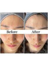 リフェイス(Re:face)/Wピール＋純国産ハーブ