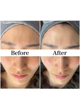 リフェイス(Re:face)/Wピール＋純国産ハーブ