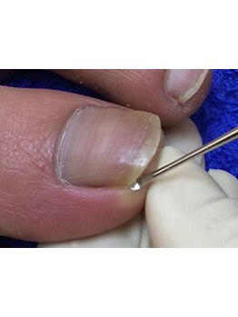 爪の悩みを解消できる（ケア含む）