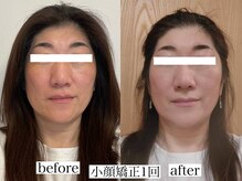 アリス(ALICE)/小顔矯正1回目