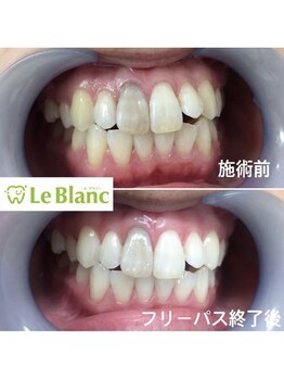 ルブラン 奈良店(Le Blanc)/神経無い歯は白くなりませんが