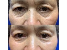 グリッター(GLITTER)/顔 &nbsp;スパアクセントディープ