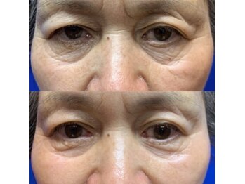 グリッター(GLITTER)/顔 スパアクセントディープ