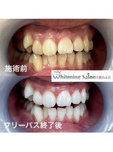 ホワイトニングサロン 京都烏丸店/ホワイトニング施術例