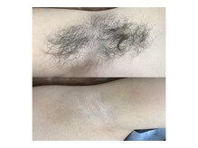 ルブレ Ginza5店(RUBURE)/【脇脱毛ビフォアフター】
