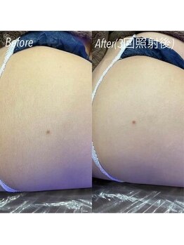 ハイリー(Hily)/ヒップ before after