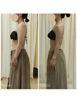 ルノン(Lunon)/《ブライダル》二の腕スッキリ