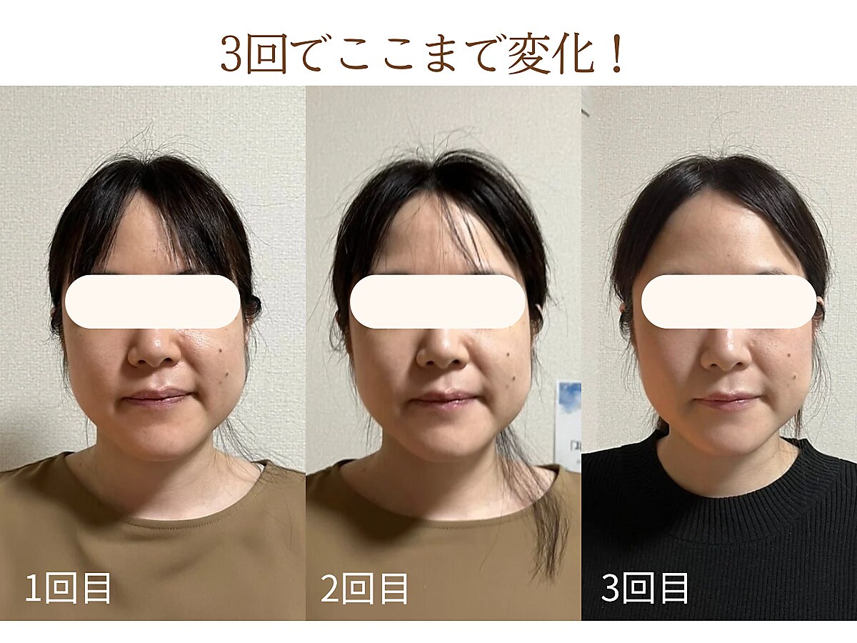 【たるみ・ほうれい線】小顔矯正＋美容整体★リフトアップ小顔へ 15,400円→