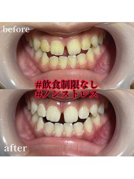 エピリス(Epiliss)/ホワイトニングビフォーアフター