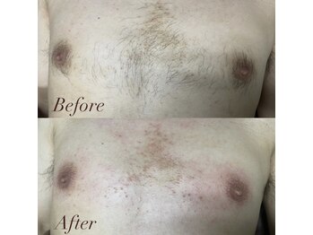 ラヴィアンクレール 梅田店(La vie en Clair)/◆胸周りワックス脱毛◆