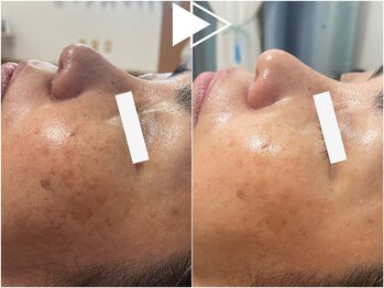 リシェス(Richesse)/シミくすみ改善★初回¥9990