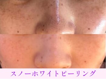 オーシャンブルー 大分店(OCEAN BLUE)/スノーホワイトピーリング