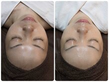 ウララ(ulala)/韓国ピーリング１回目/5回目