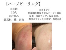 サロンツキ(salon tuki)/ハーブピーリング/徳島