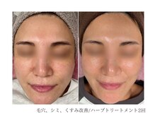 ルーム(room)/ハーブトリートメント2回