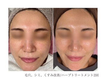 ルーム(room)/ハーブトリートメント2回