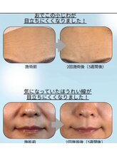 クレビア(Crebia)/水光ボツリヌス導入エステ