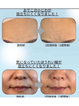 クレビア(Crebia)/水光ボツリヌス導入エステ
