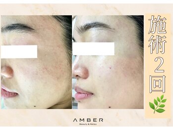 アンバー 恵比寿(AMBER)/DT有ハーブピーリング