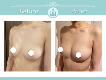 美人バスト 川崎店/バストアップ◇症例◇