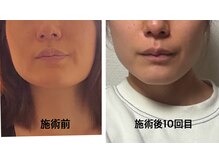 パールブリス(Pearlbliss)の雰囲気（継続は裏切らない！希望通りの輪郭になってご本人も驚いてる20代）